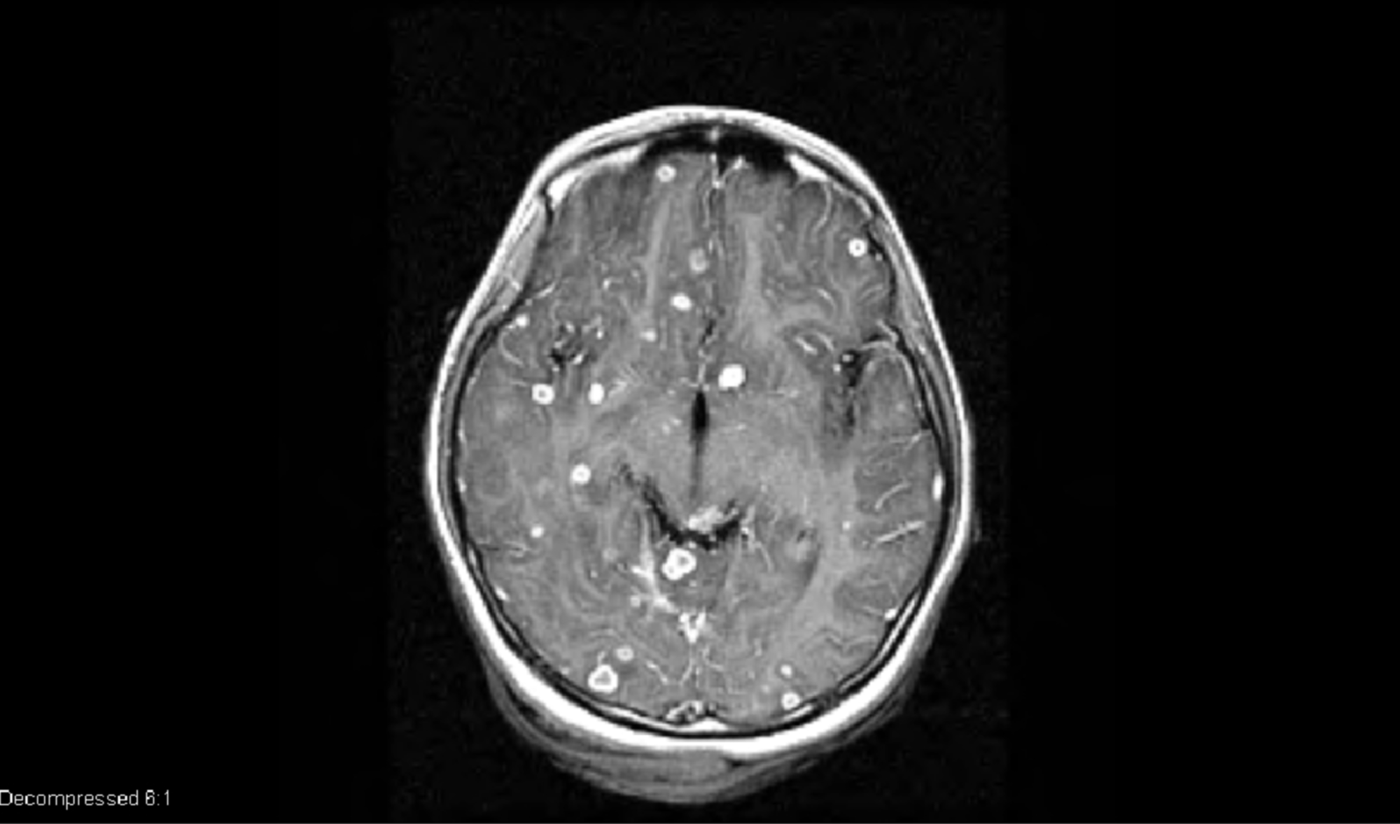 Cureus Multiple Intracranial Tuberculomas With An Intra Medullary