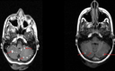 Multiple Intracranial Tuberculomas With An Intra Medullary Spinal Cord