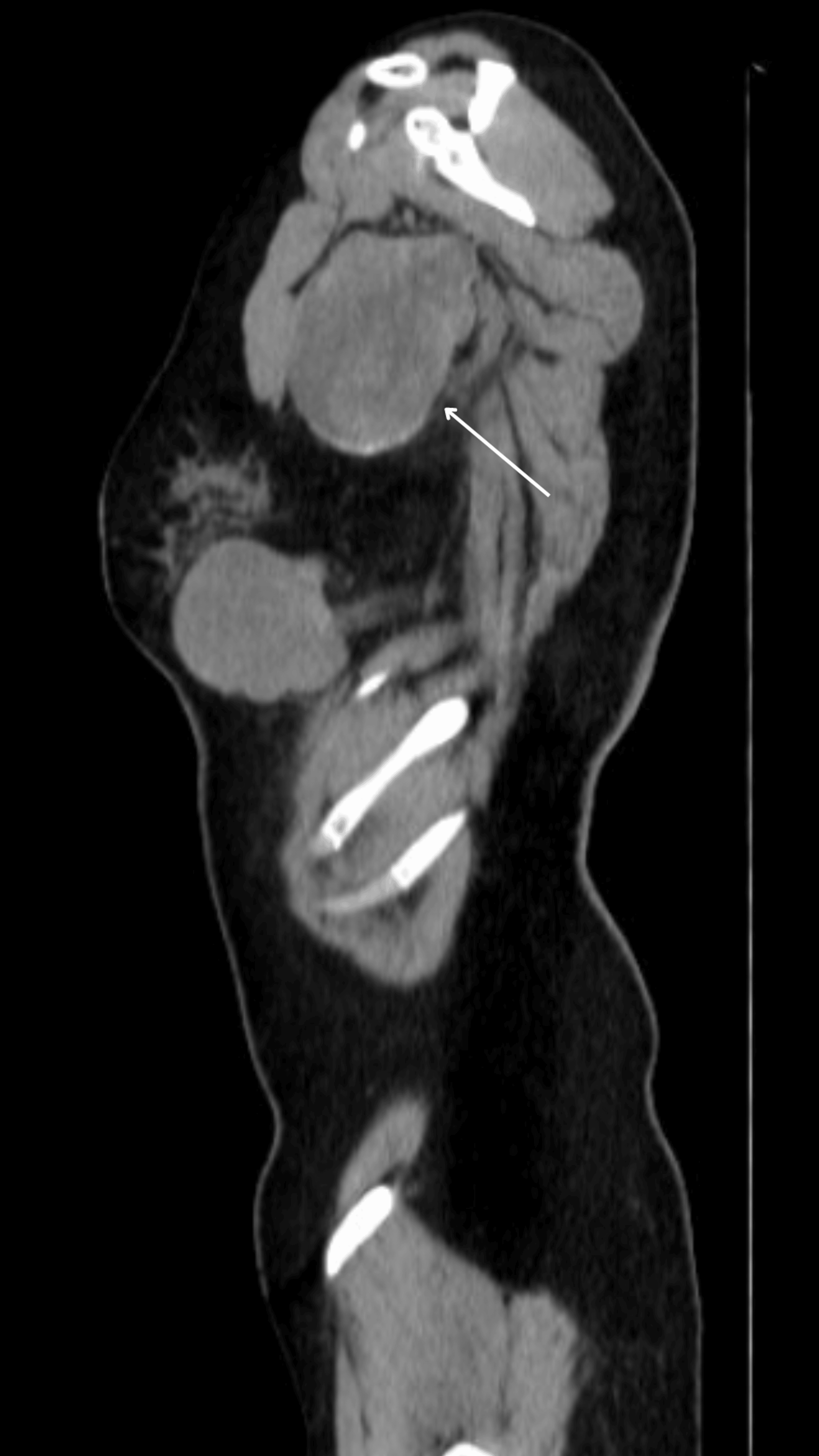 Breast Metastasis From Cutaneous Melanoma Beyond The Infiltrating