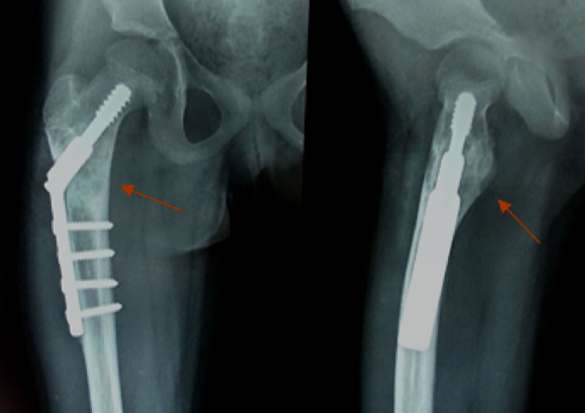 Cureus Aneurysmal Bone Cyst Of The Proximal Femur And Its Management