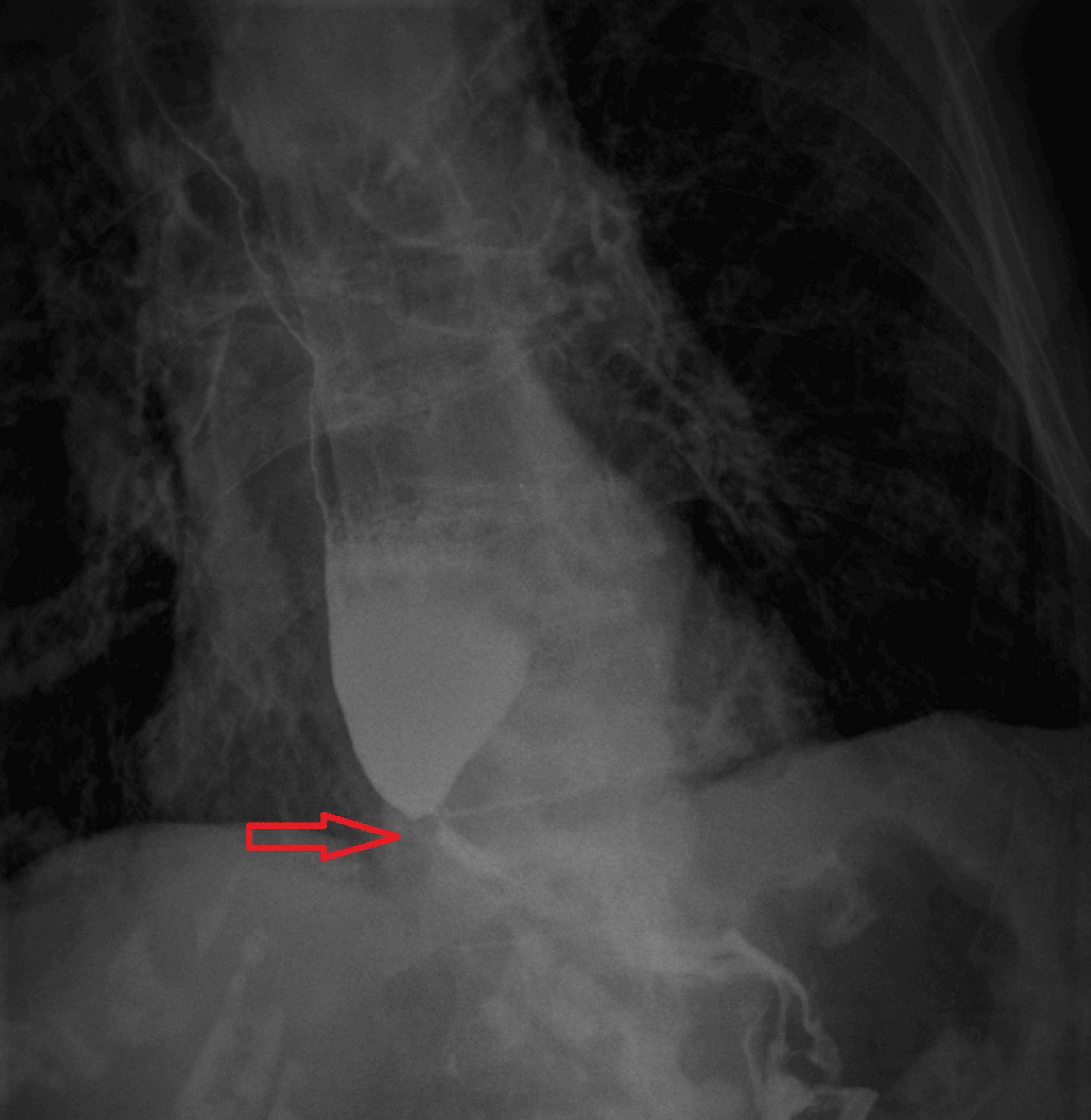 Cureus A Rare Coexistence Achalasia Esophagus And Acute Intestinal