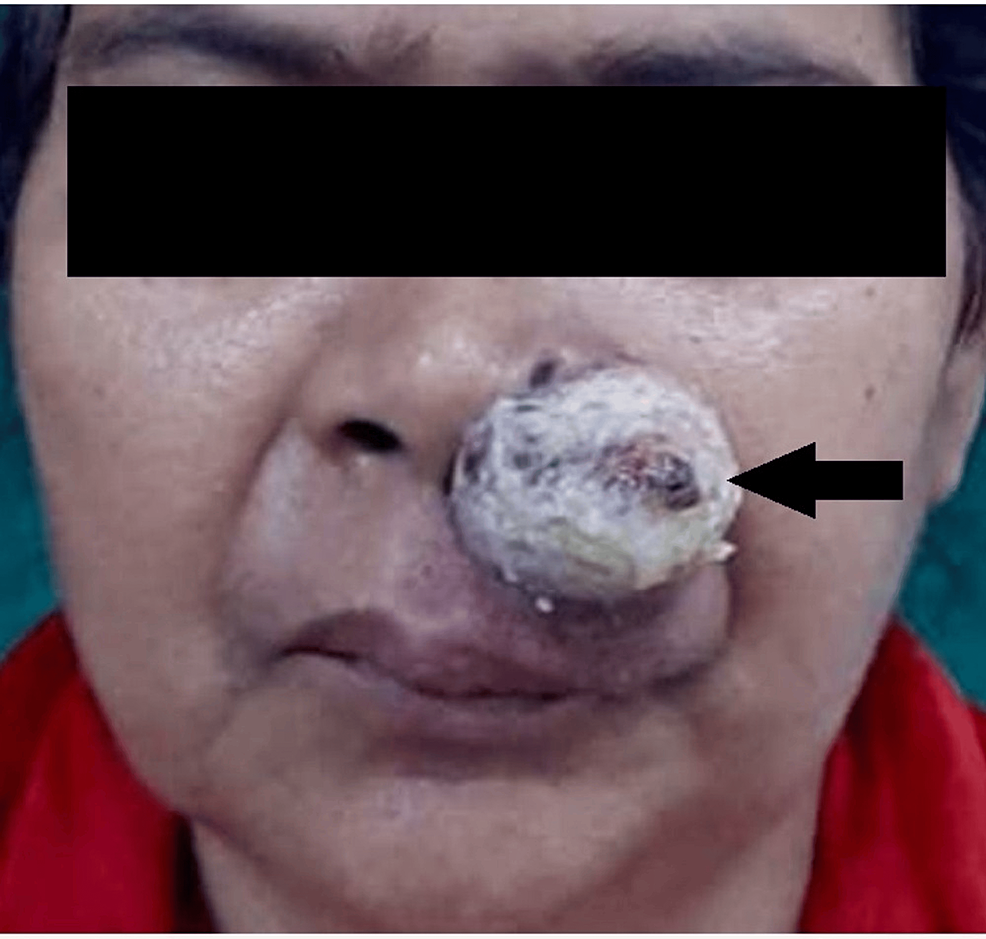 A Rare Presentation Of Malignant Melanoma Of The Face A Case Report