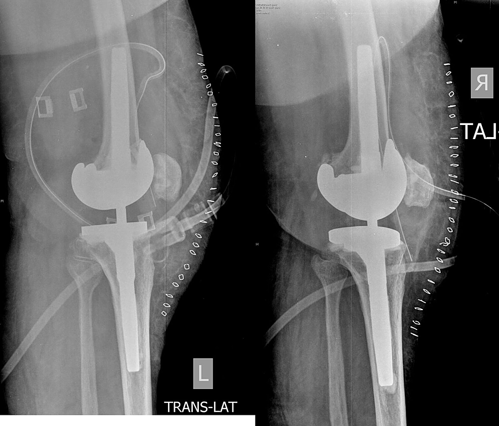 Cureus | Bilateral Simultaneous Revision Total Knee Arthroplasty As A ...