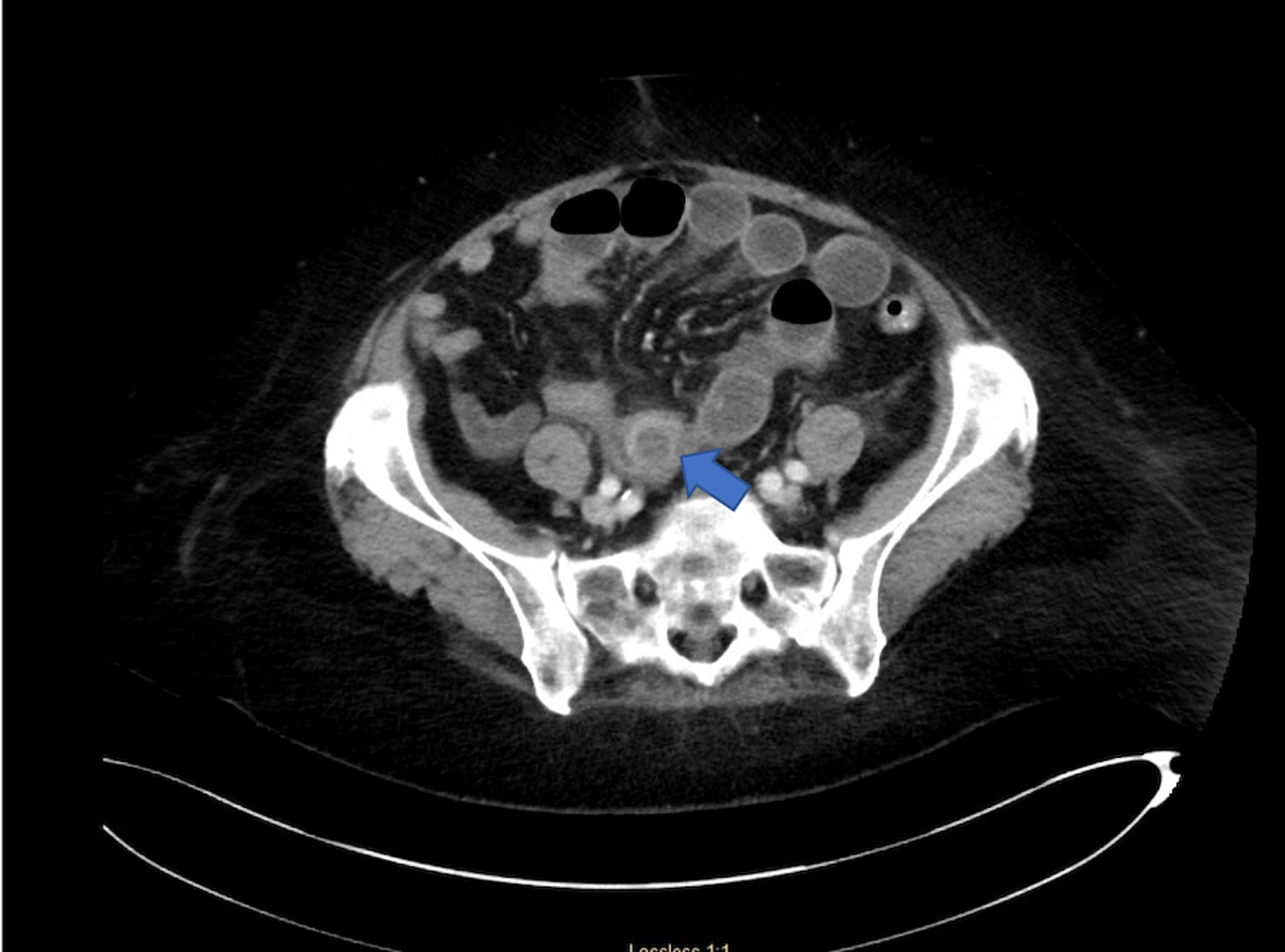 Cureus Laparoscopic Approach For Gallstone Ileus In Geriatric Patients