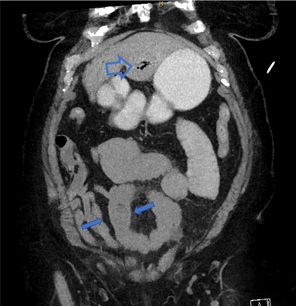 Cureus Laparoscopic Approach For Gallstone Ileus In Geriatric Patients