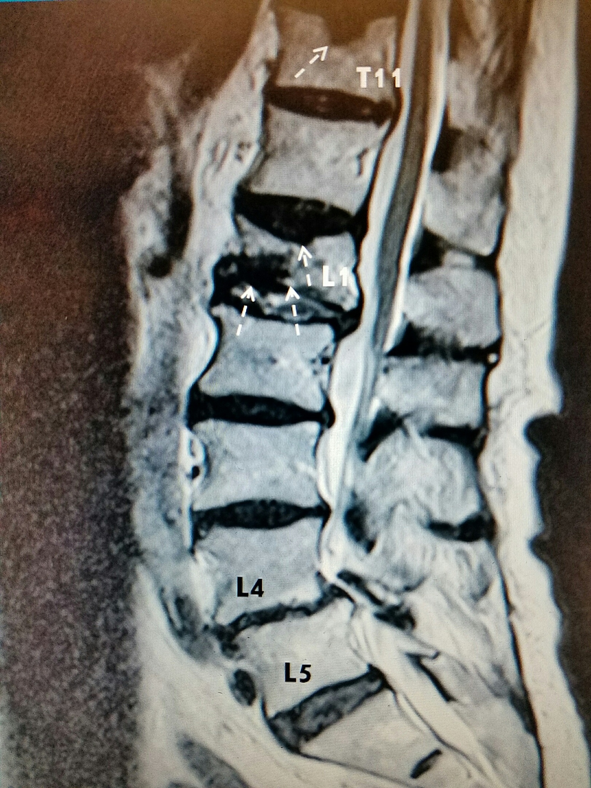 t8 compression fracture