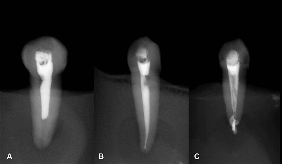 Cureus Comparative Evaluation Of The Quality Of Obturation Between