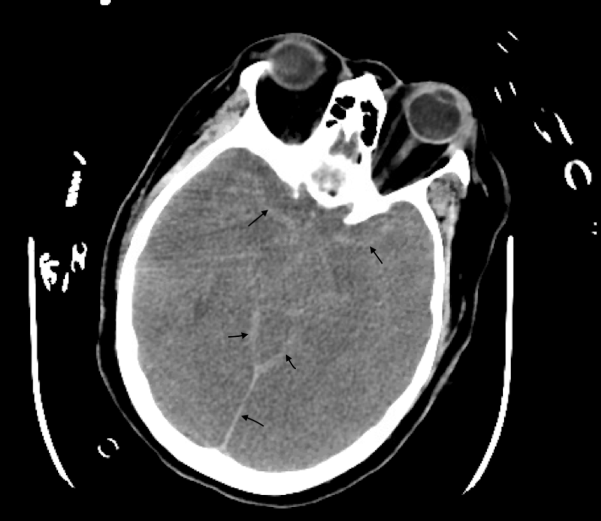 Cureus Intracranial Hemorrhage In A Patient With Covid Possible My Xxx Hot Girl