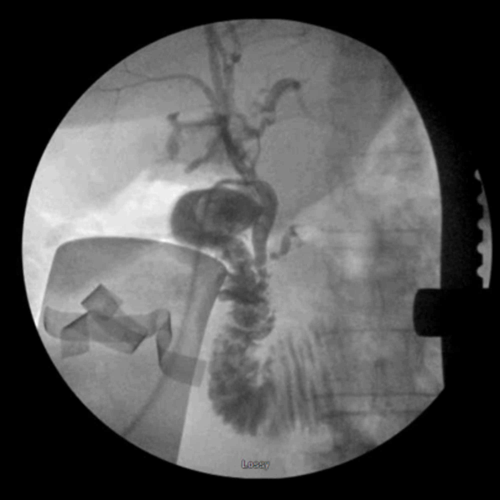 Cureus Conservative Management Of Mirizzi Syndrome In Community