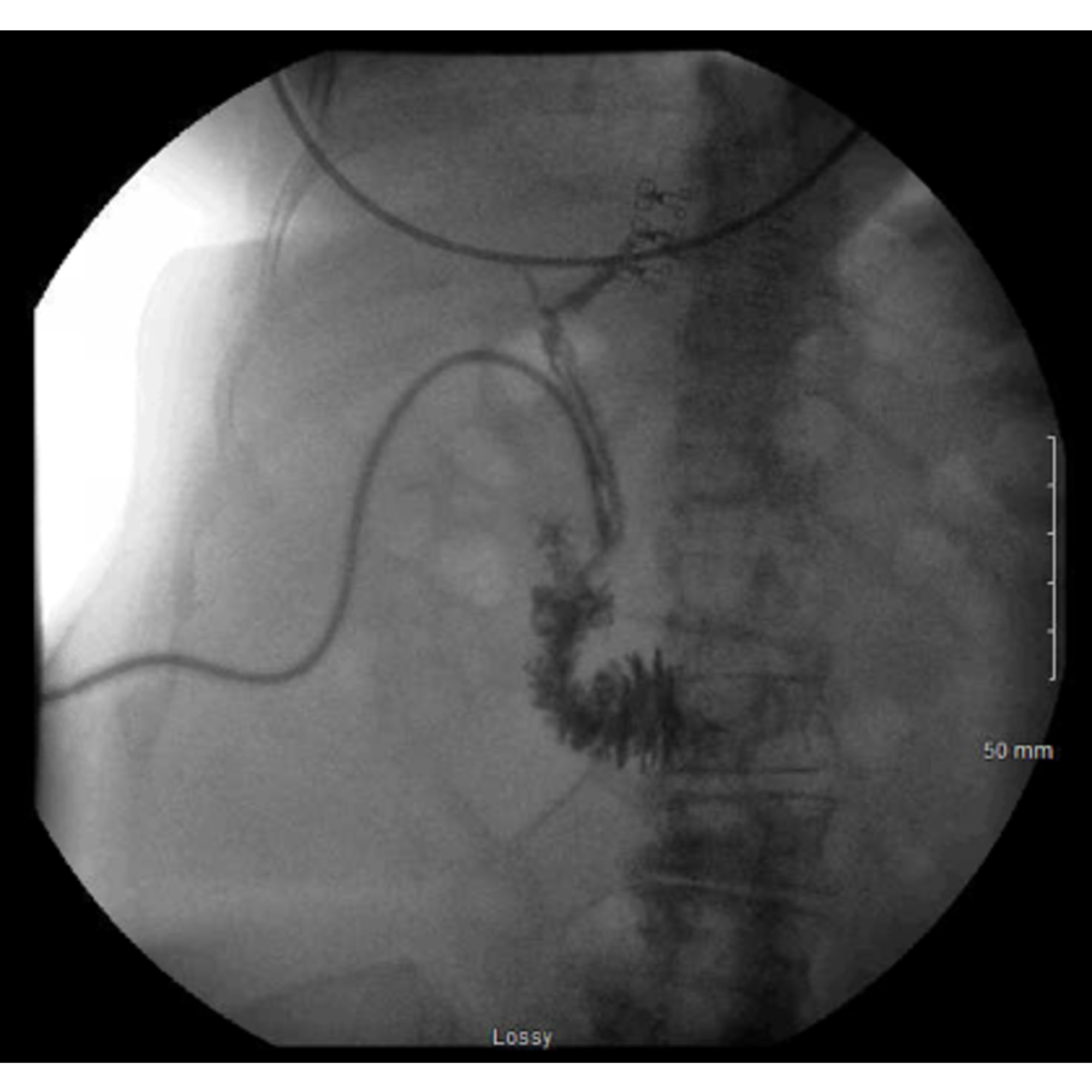 Cureus Conservative Management Of Mirizzi Syndrome In Community