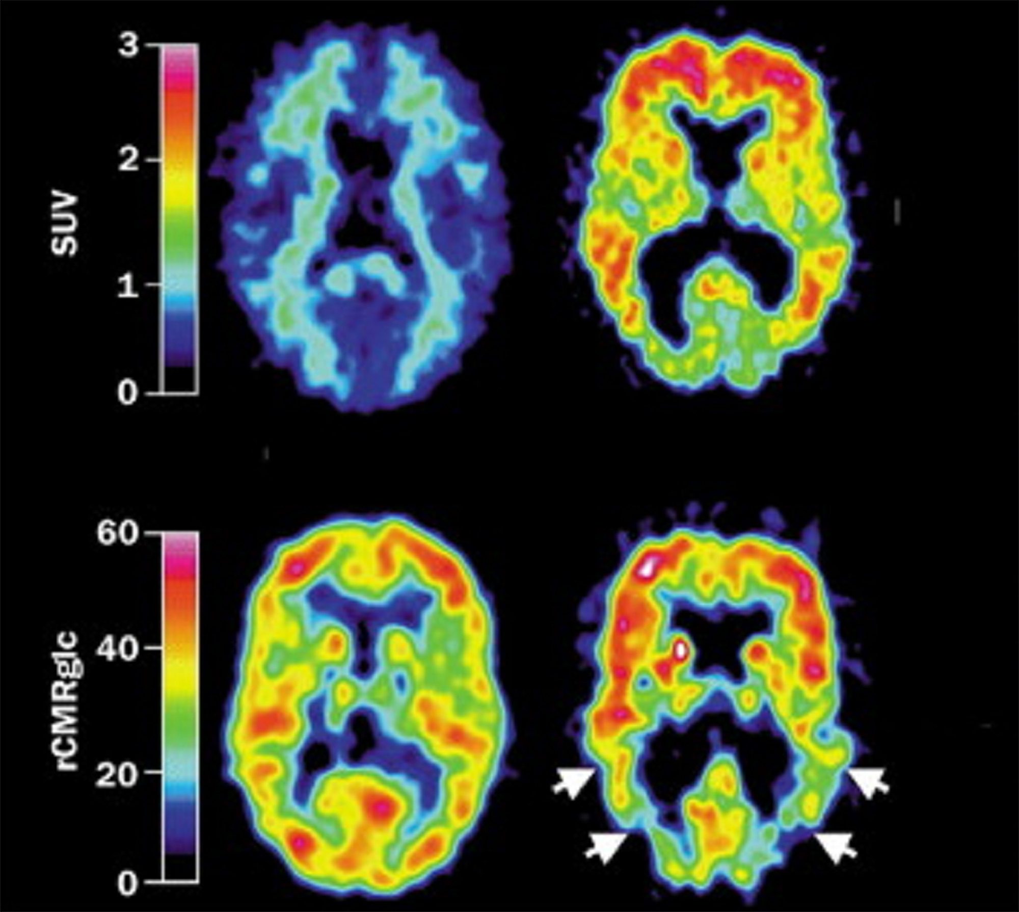 download bipolar disorders 100