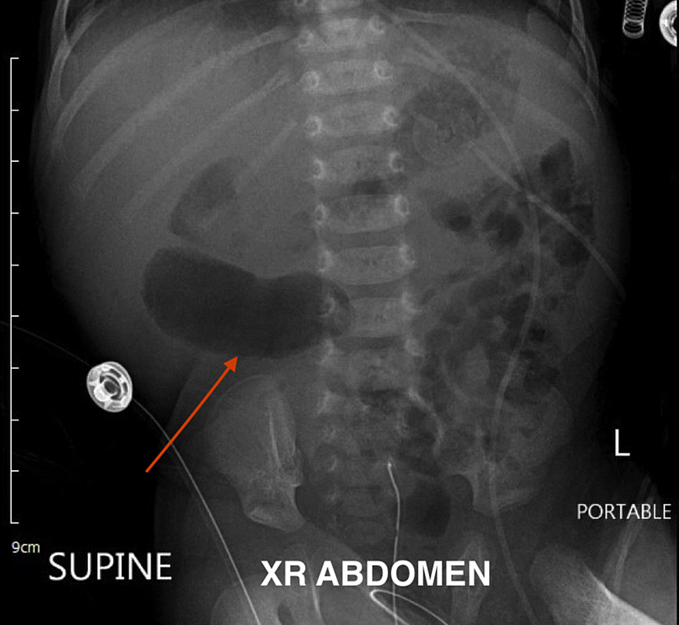 Cureus Duodenal Stenosis A Diagnostic Challenge In A Neonate With