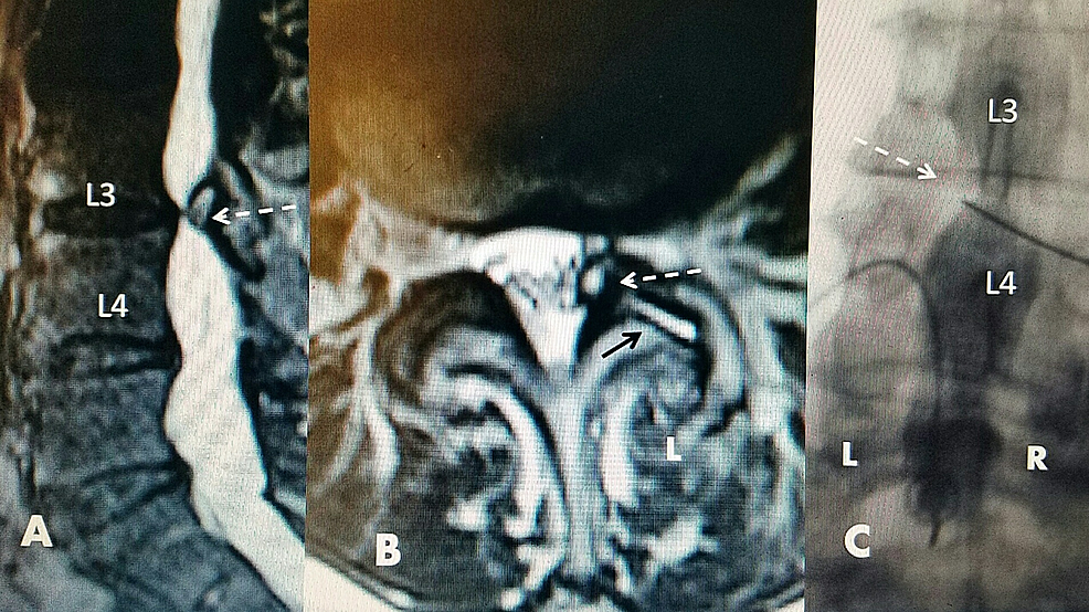 L3-4-facet-cyst:-magnetic-resonance-image-(MRI)-and-intraoperative-films