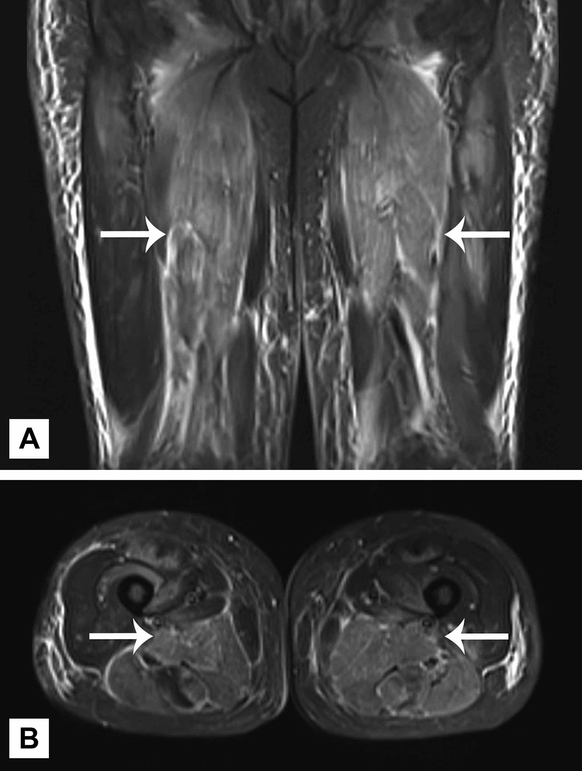 Cureus Statin Induced Immune Mediated Necrotizing Myopathy An Increasingly Recognized