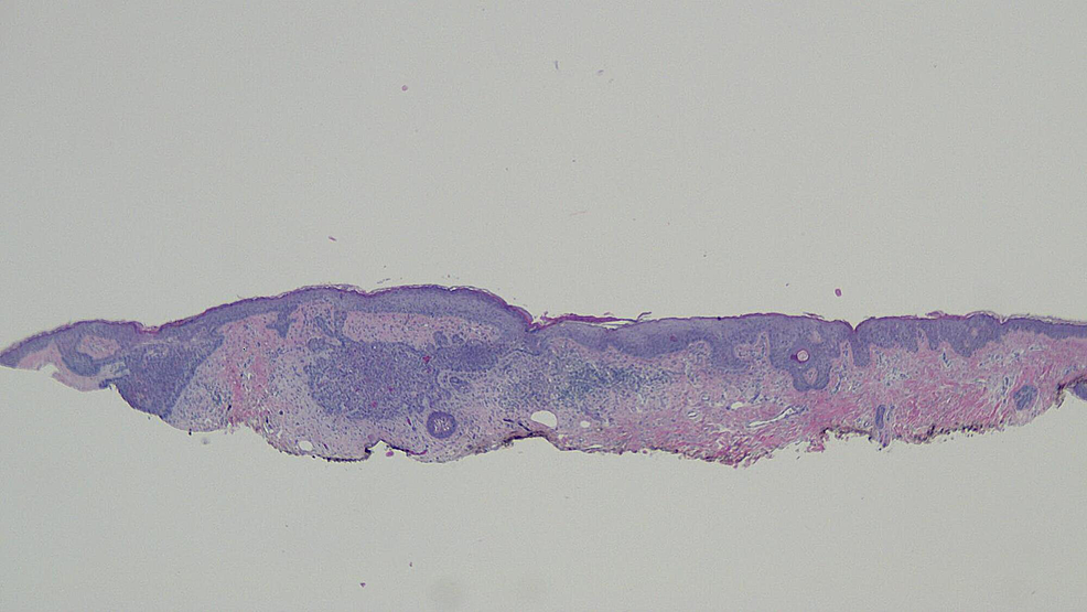 Cureus Red Dot Basal Cell Carcinoma Report Of Cases And Review Of This Unique Presentation Of 5786