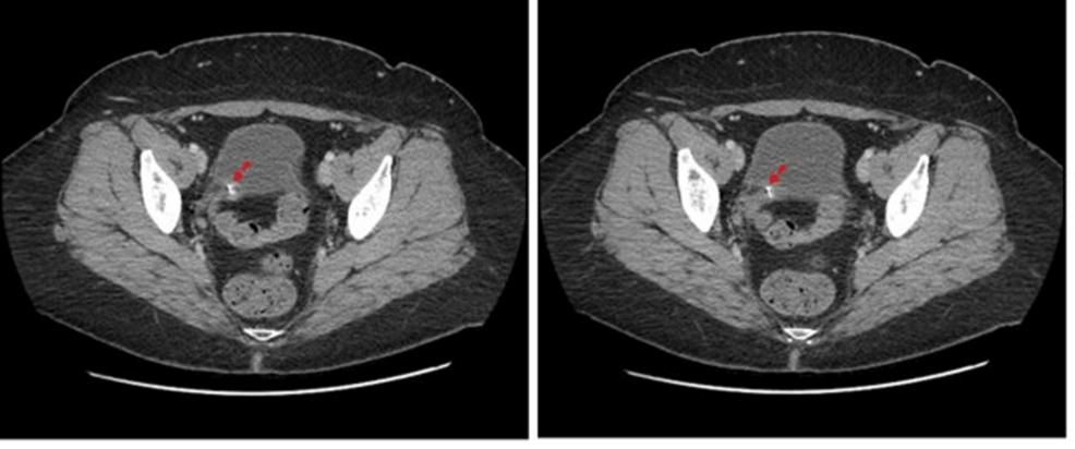 Catheter Displacement And Penetration Of A Vaginal Cuff Following