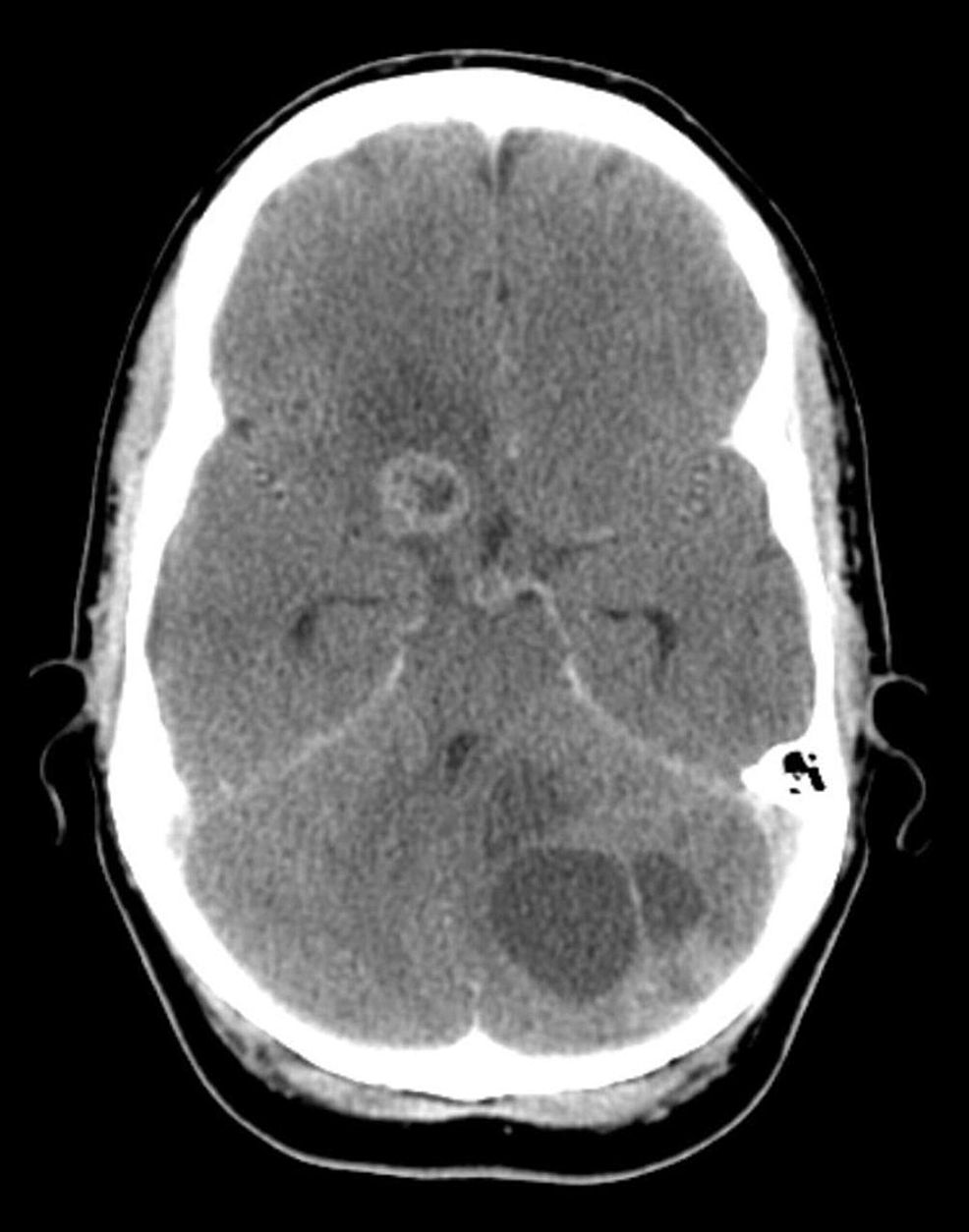 Cureus Exceptional Responses to Standard Therapy in a