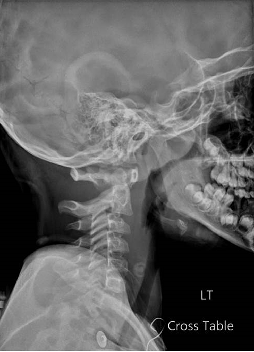 c1 c2 c3 cervical spine x ray