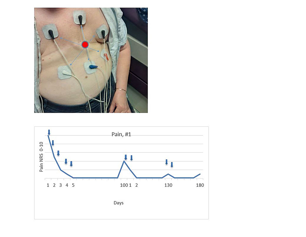 Electrode-Placement,-Case-1