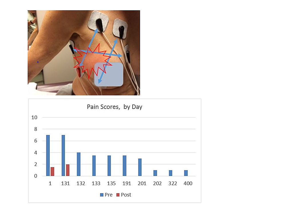 Electrode-Placement,-Case-3