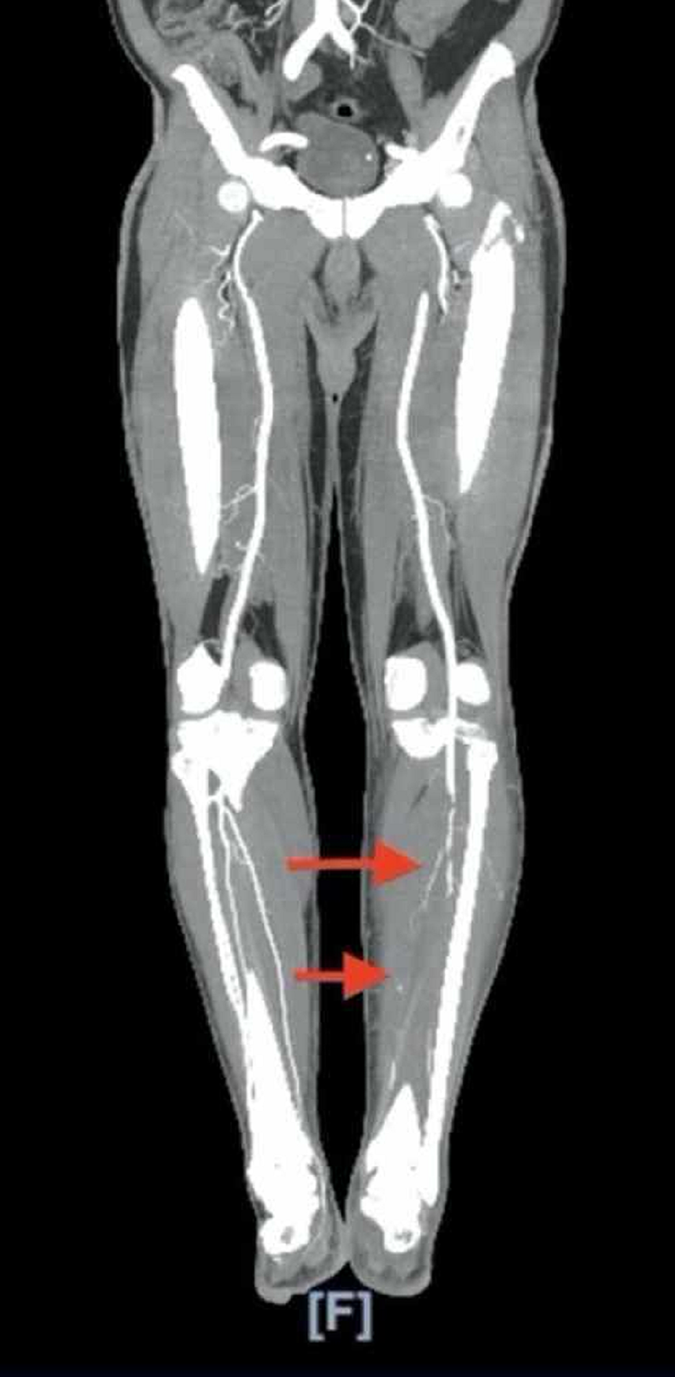 Cureus Covid Presenting As Acute Limb Ischemia