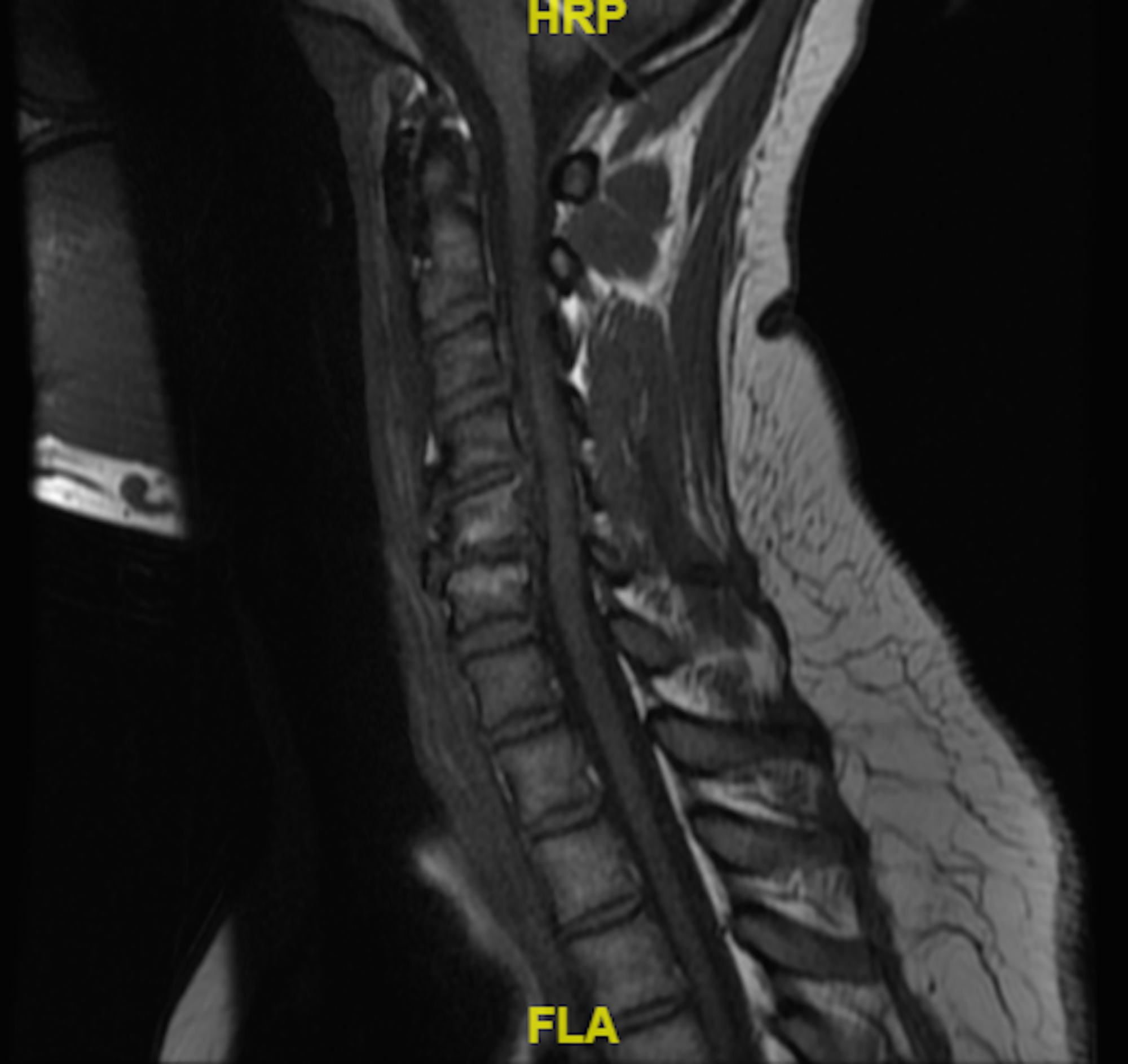 Cureus Acute Calcific Tendonitis Of The Longus Colli An Uncommon