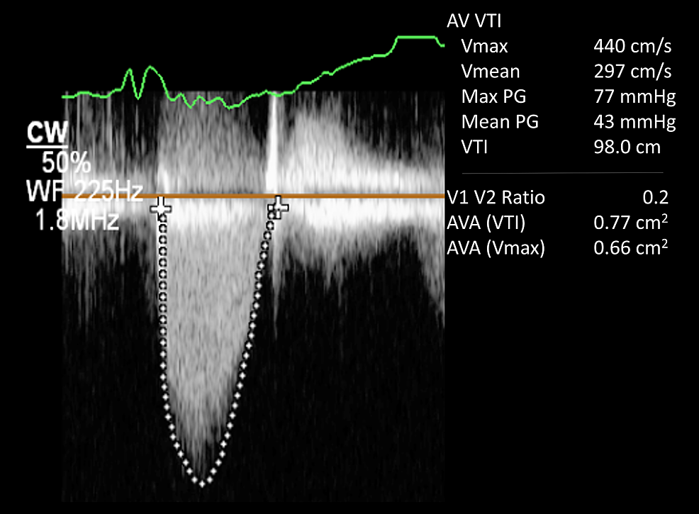 What Is Peak Gradient In Aortic Stenosis