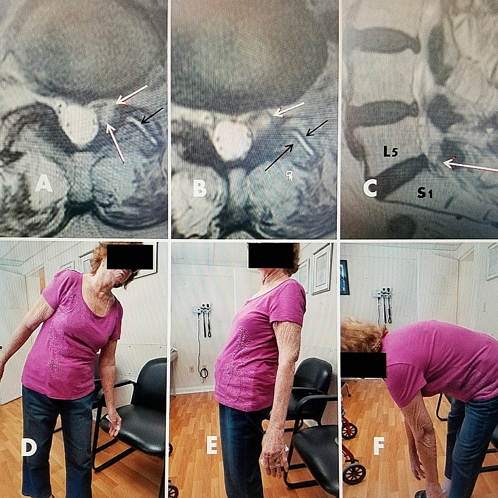 79-year-old-female-with-L5-S1-foraminal-cyst-with-radiculopathy