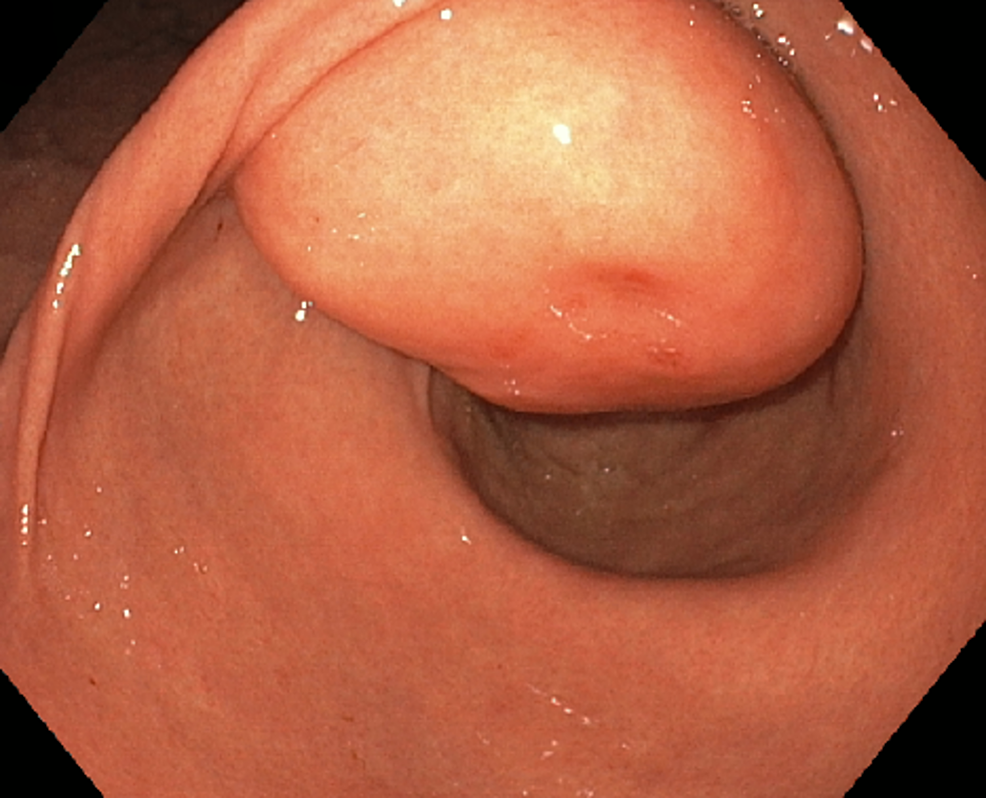 Bleeding Gastric Lipoma Resected By Endoscopic Submucosal Dissection