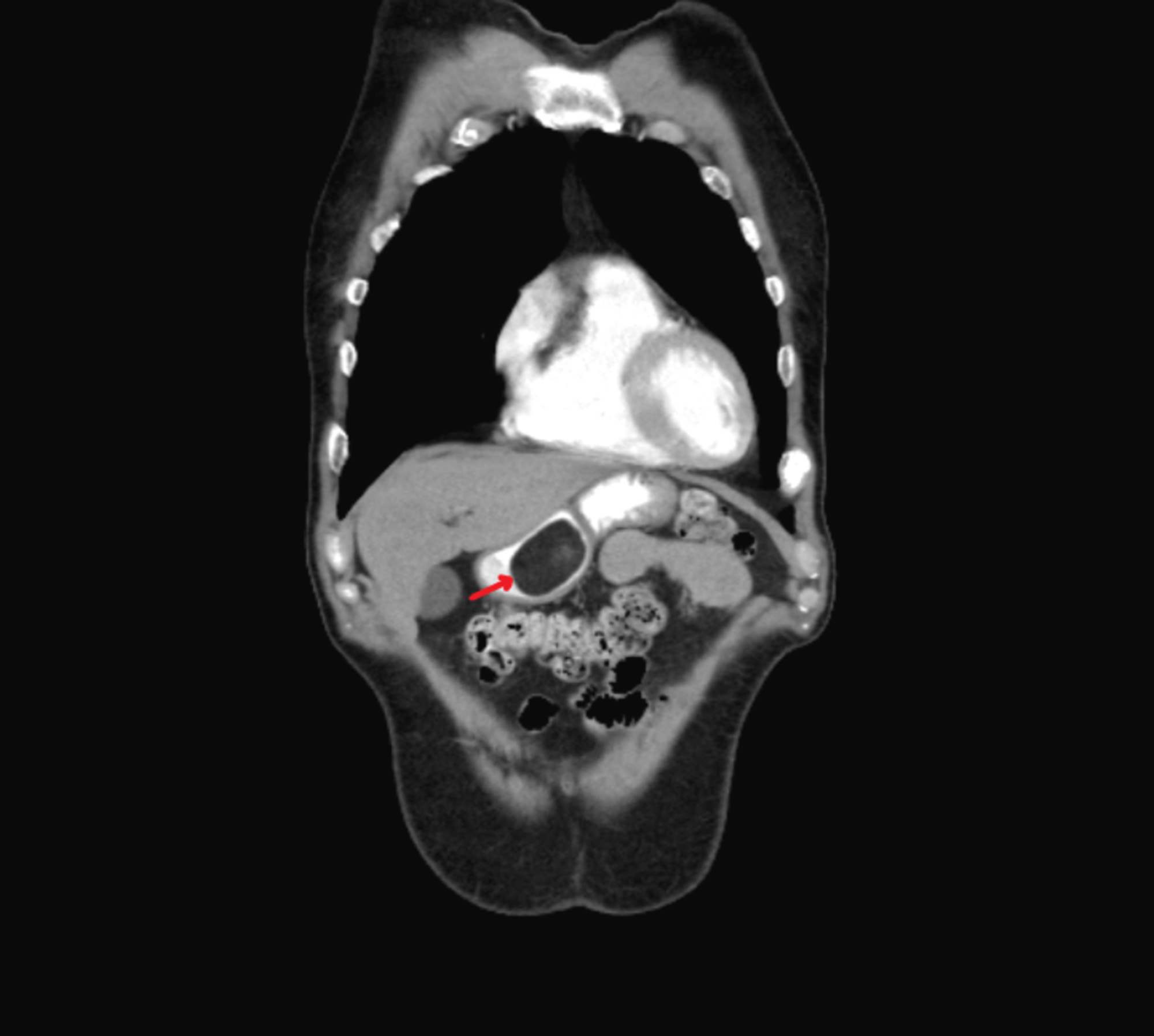 Cureus Bleeding Gastric Lipoma Resected By Endoscopic Submucosal