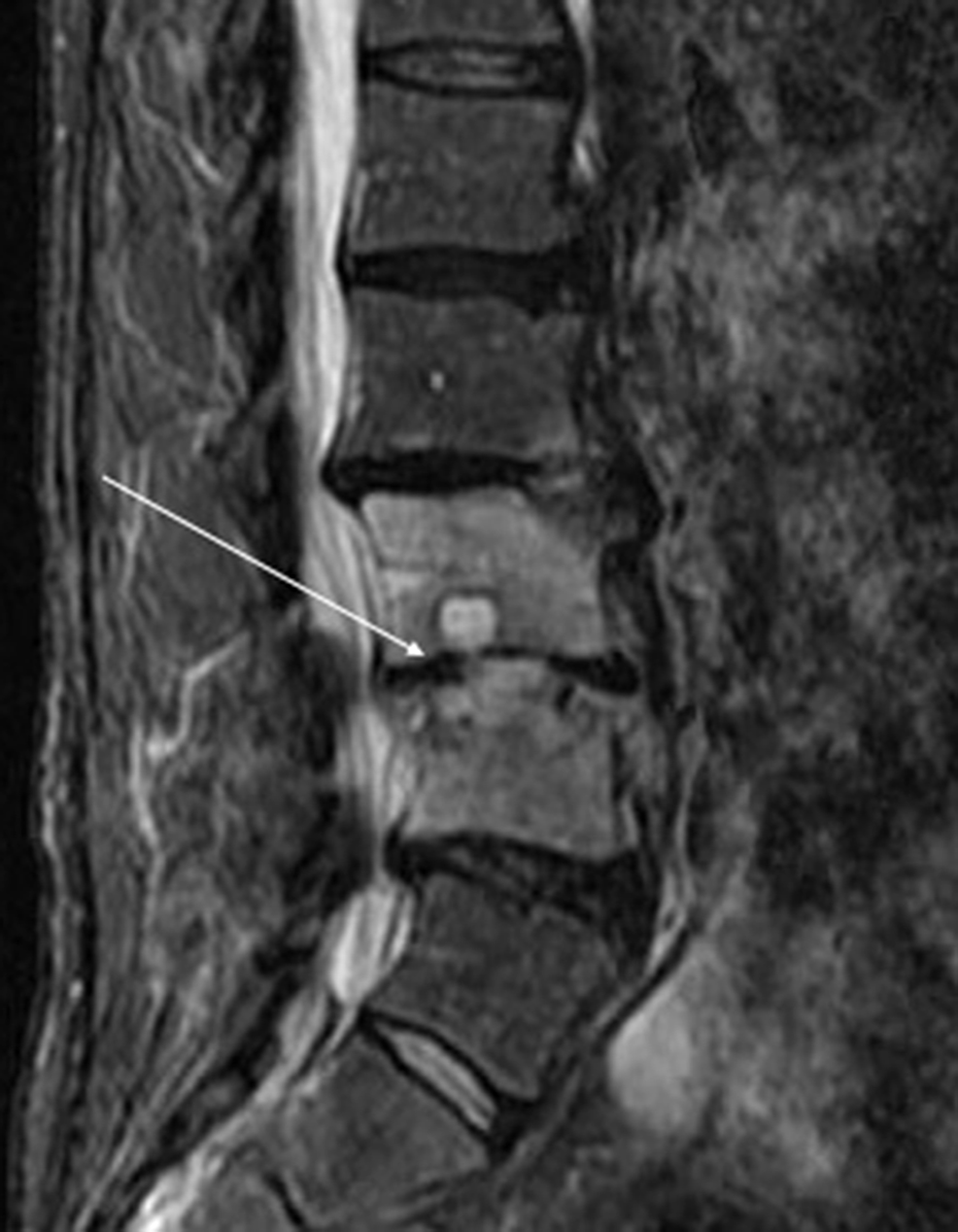 Non-contrast-T2-MRI-of-the-spine.-There-is-evidence-of-osteomyelitis-at-the-L2-L3-and-L3-L4-intervertebral-levels-with-abscess-in-the-disc-space-at-the-L3-L4-and-anterior-aspect-of-the-disc-at-L2-L3.