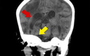 A Rare Case Of Malignant Infantile Osteopetrosis Presenting As Frontal