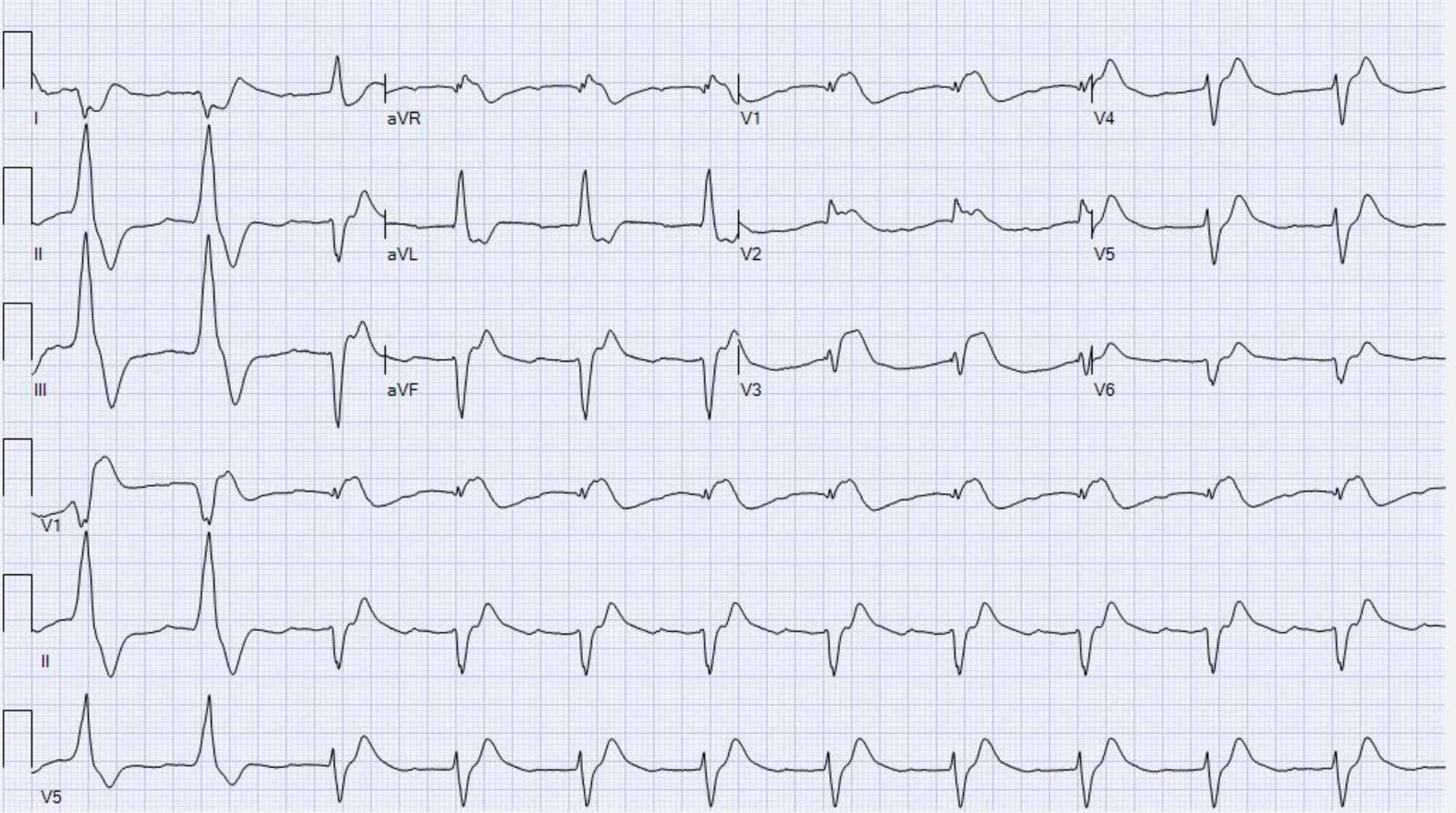 Un caso raro de embolia pulmonar que se presenta con elevación del ST