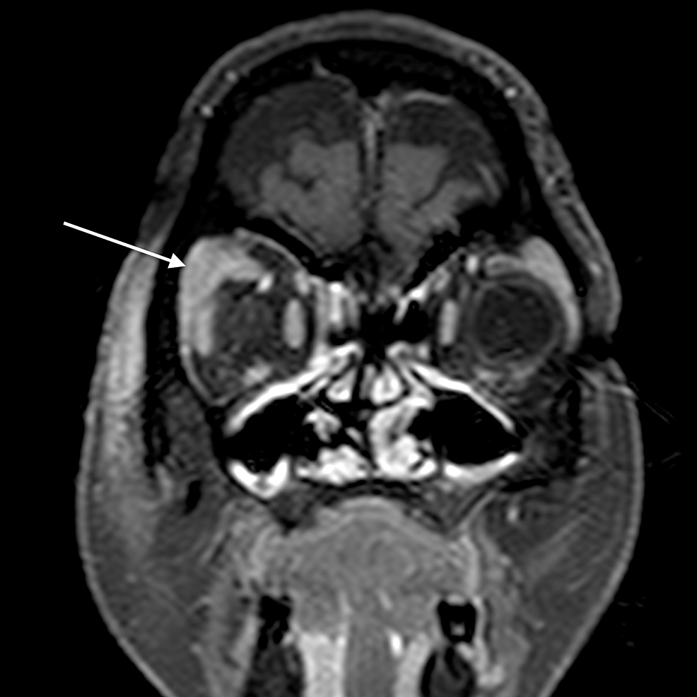 Cureus Spectrum Of Orbital Cellulitis On Magnetic Resonance Imaging