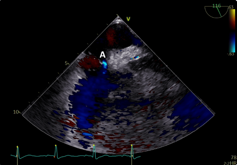 Platypnea Orthodeoxia Syndrome Manifestation Of A Patent Foramen Ovale