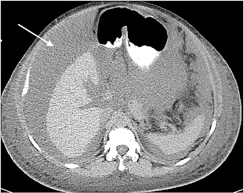 cureus-chylous-ascites-in-systemic-lupus-erythematosus-a-diagnostic