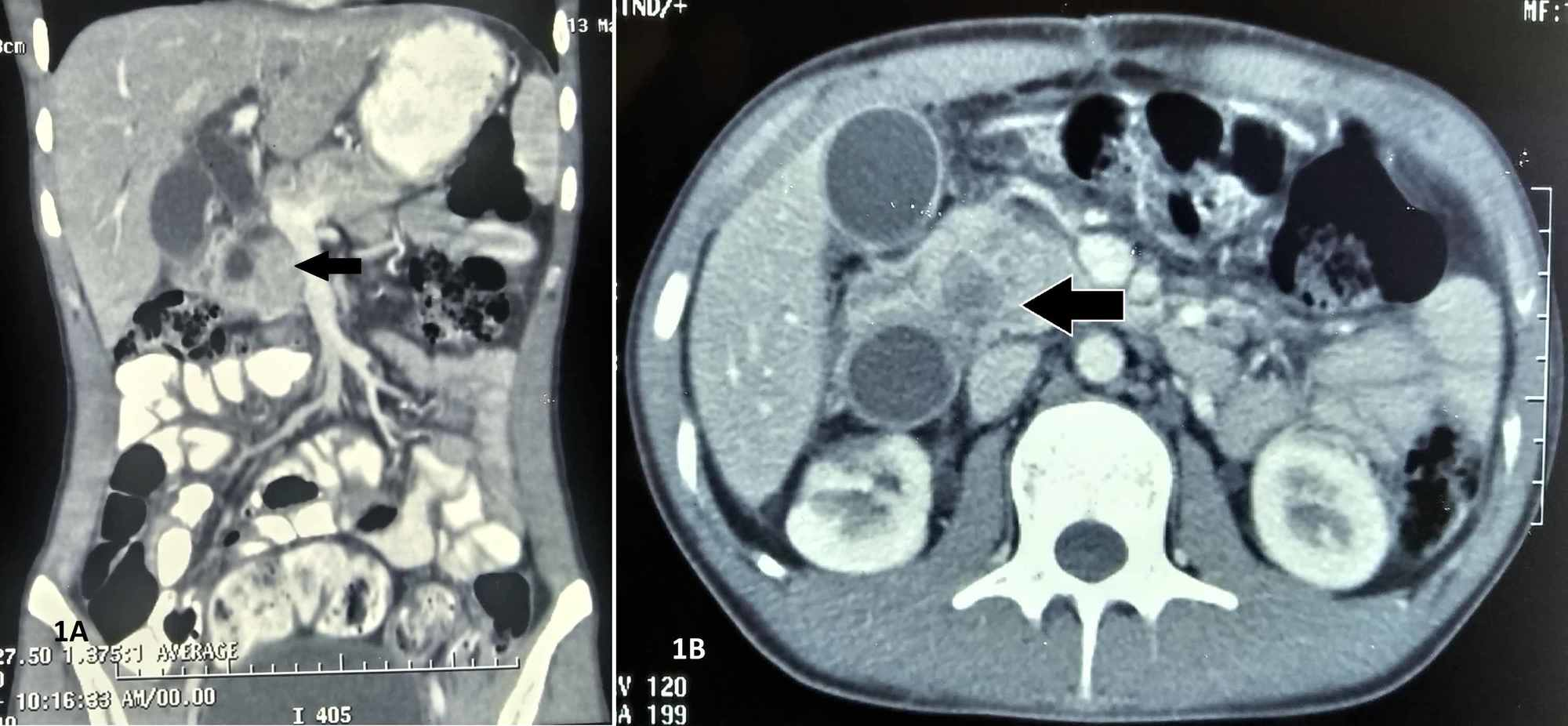 Post Traumatic Lemmels Syndrome A Rarest Of Rare Cause Of Obstructive