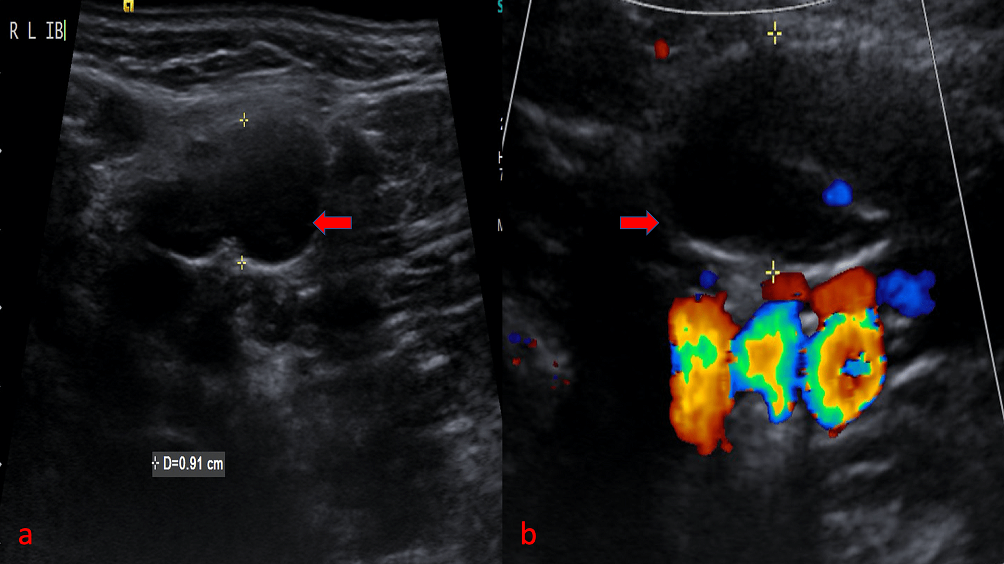 Cureus Evaluation Of B Mode And Color Doppler Ultrasound In The