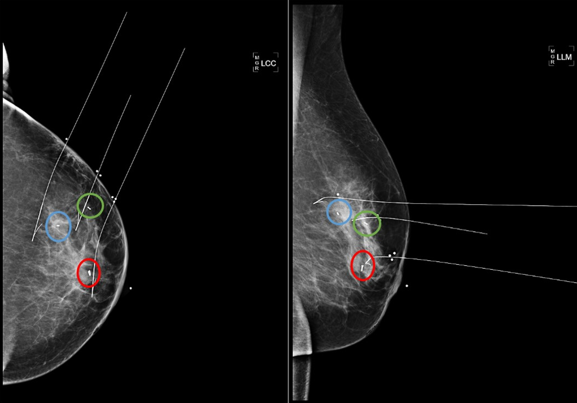 Cureus Successful Lumpectomy In A Patient With Multicentric Breast Cancer