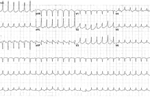 Article_box_fb497cf0329611e7828fd9b038fc2028-figure-1---tachycardia