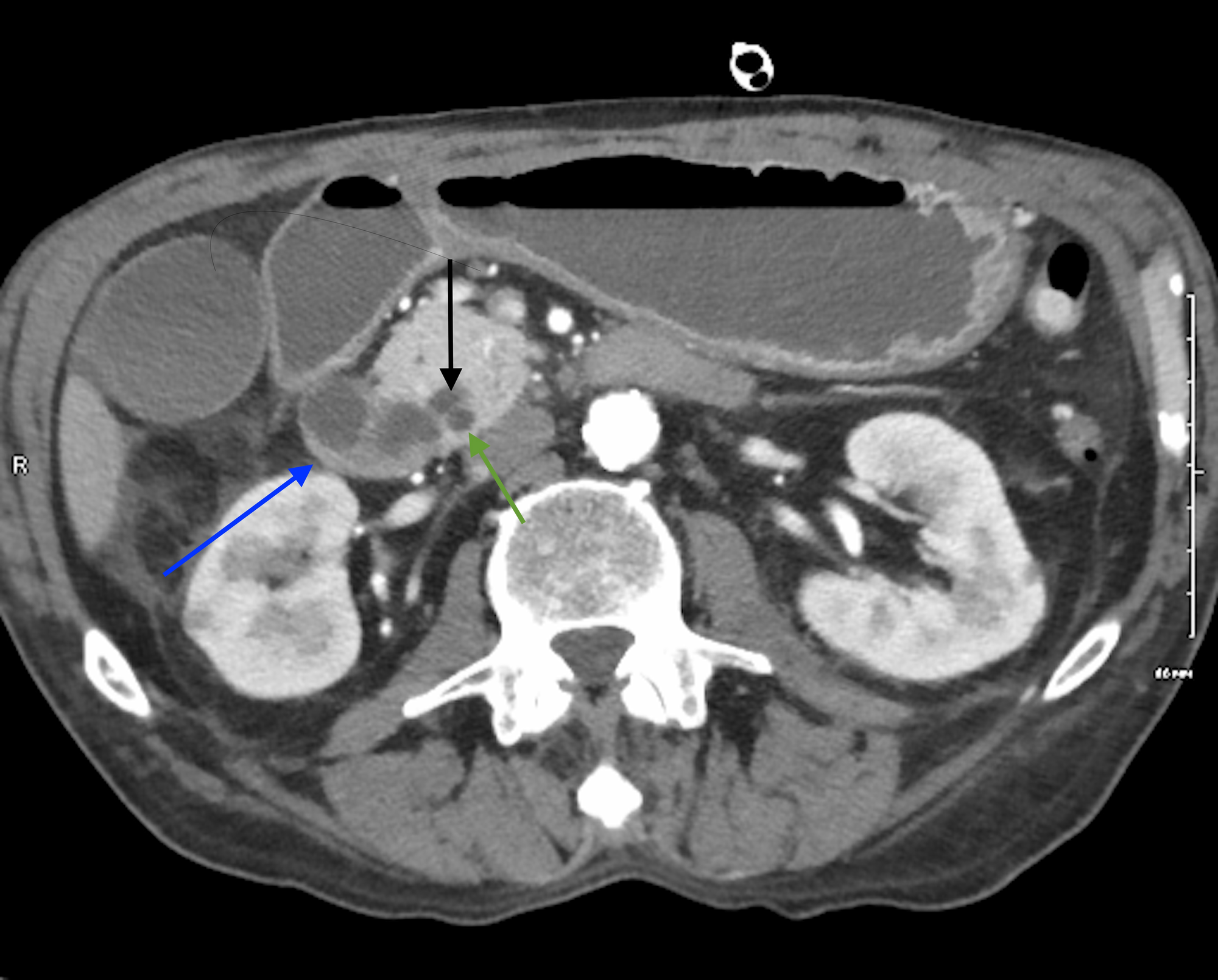 Cureus Ampullary Adenocarcinoma Causing Small Intestinal Obstruction