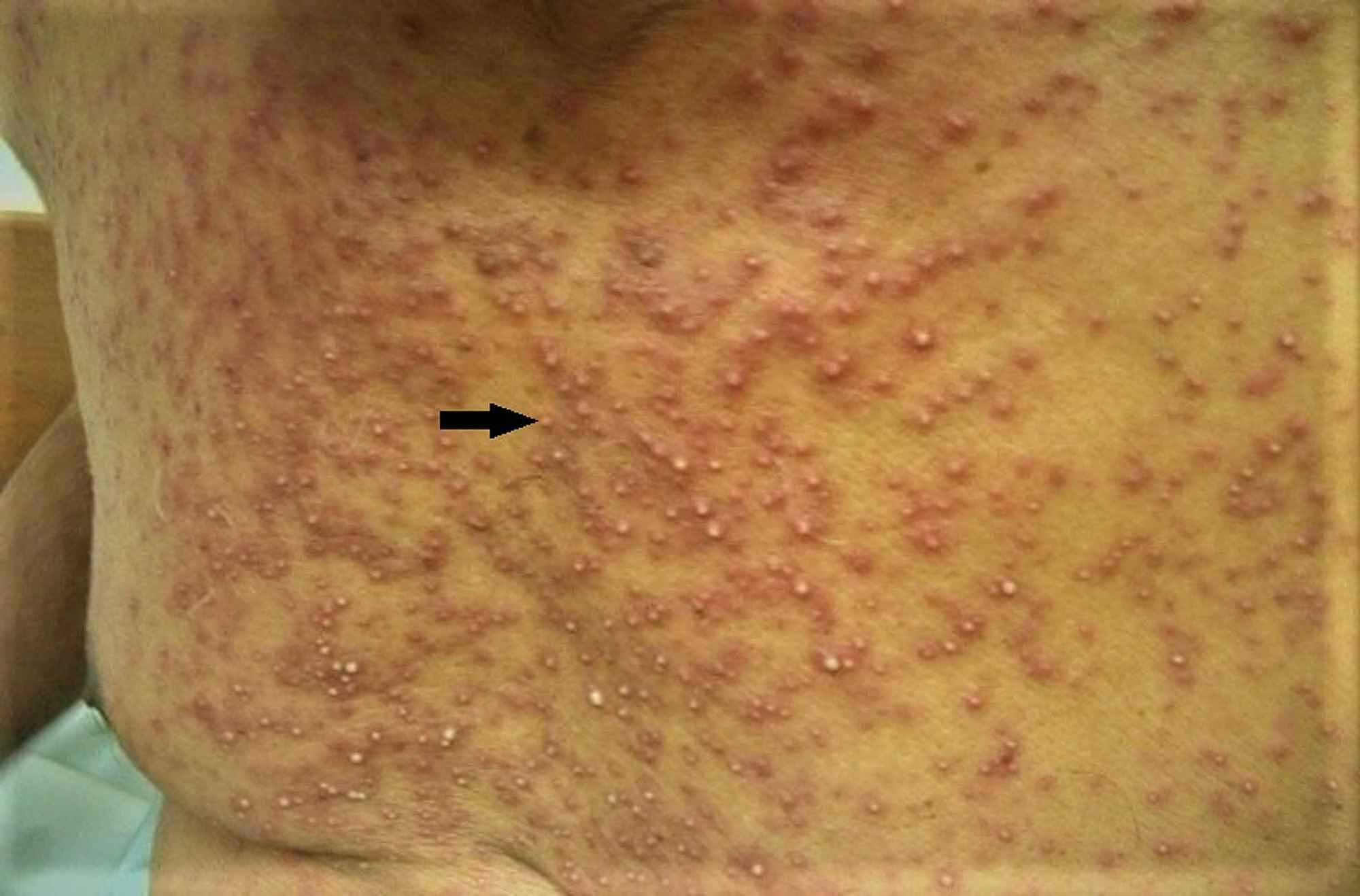 Cureus Acute Generalized Exanthematous Pustulosis Induced By Cetuximab