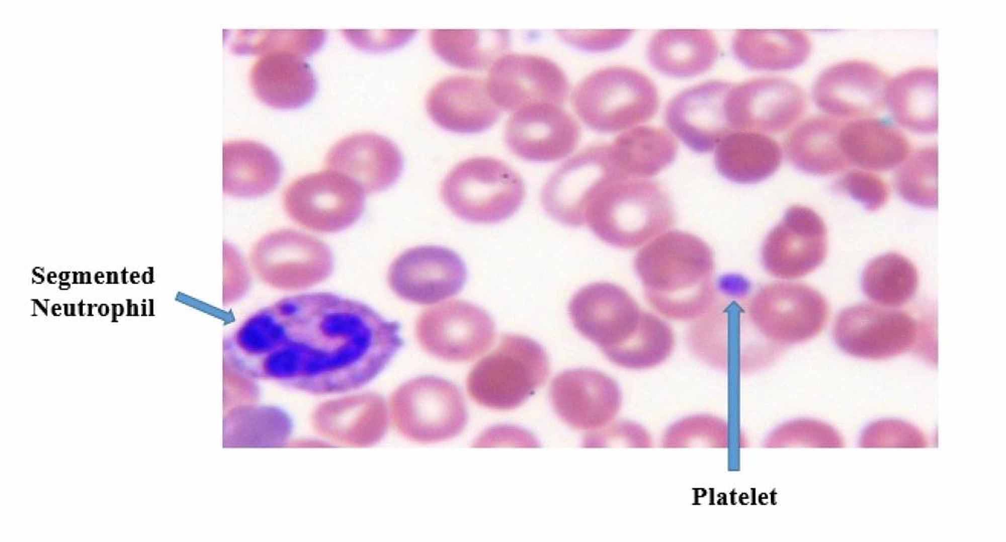 Cureus Thrombocytopenia With Absent Radii Tar Syndrome Without