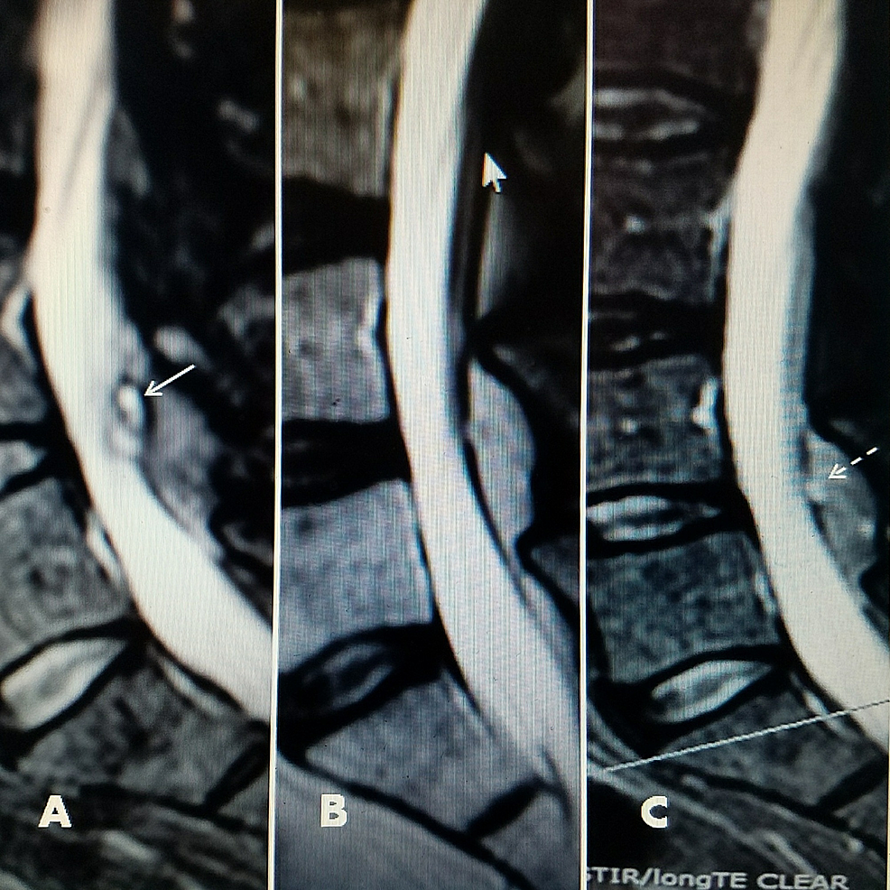 Pre-RF-and-post-RF-followup-MRI-scans
