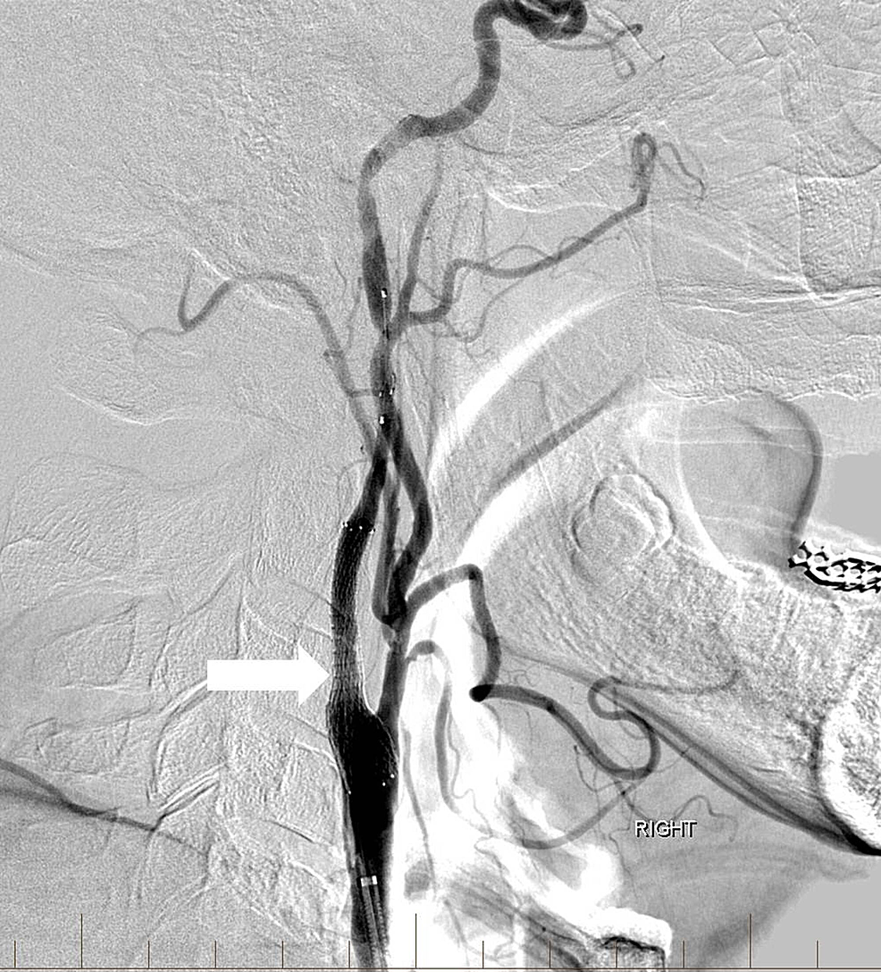 Lateral-digital-subtraction-angiography-image-after-balloon-angioplasty-and-stenting-with-a-distal-protection-device