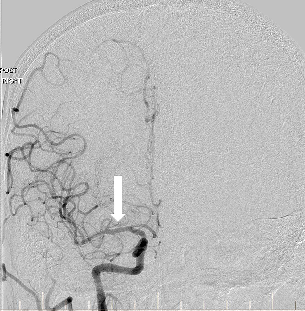 Frontal-image-of-a-right-common-carotid-artery-injection-after-angioplasty-and-stenting-reveals-recanalization-of-the-right-anterior-circulation-with-normal-intracranial-flow-(arrow).