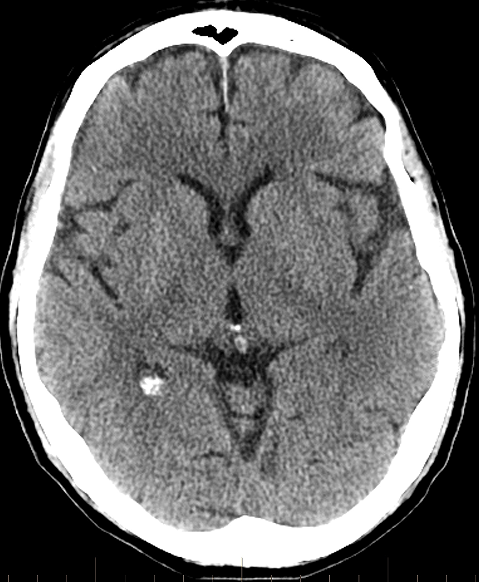 Follow-up-head-computed-tomography-performed-early-the-next-day-shows-no-significant-acute-infarction-or-intracranial-hemorrhage.