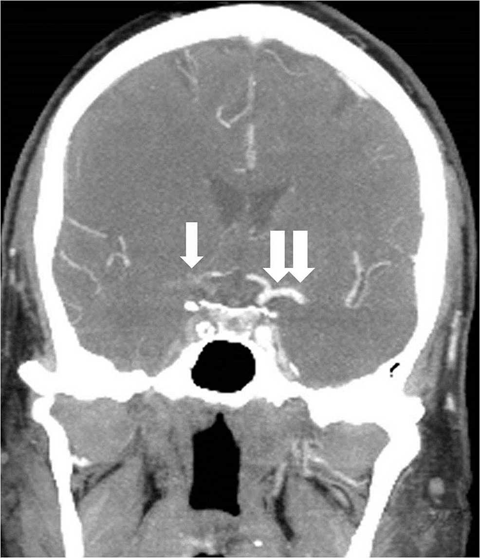 Coronal-reconstruction-from-a-computed-tomography-angiogram-reveals-a-complete-occlusion-of-the-right-middle-cerebral-artery-and-supraclinoid-internal-carotid-artery-(single-arrow)