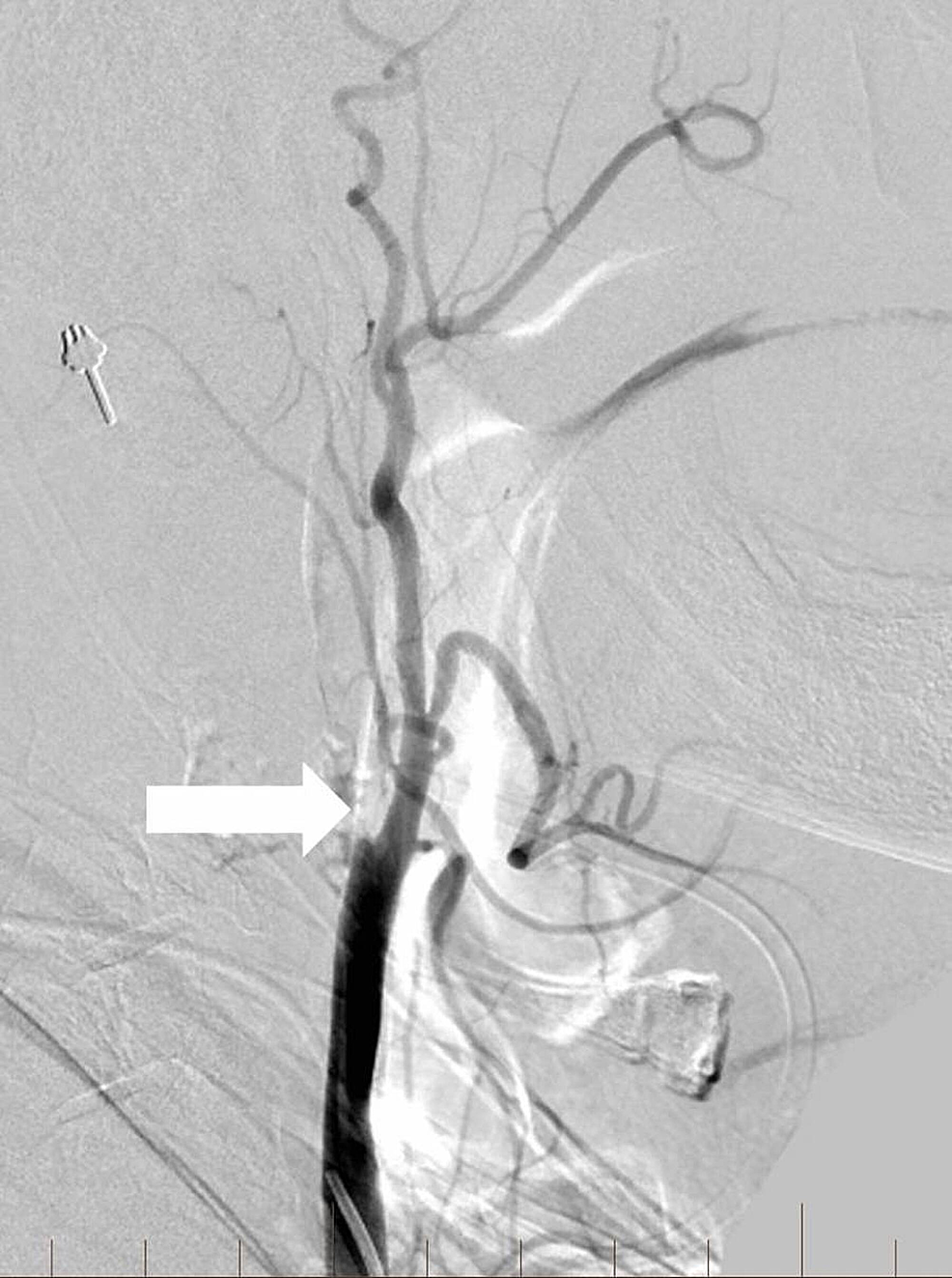 Lateral-digital-subtraction-angiography-image-of-the-right-common-carotid-artery-shows-complete-occlusion-of-the-extracranial-internal-carotid-artery-(arrow).