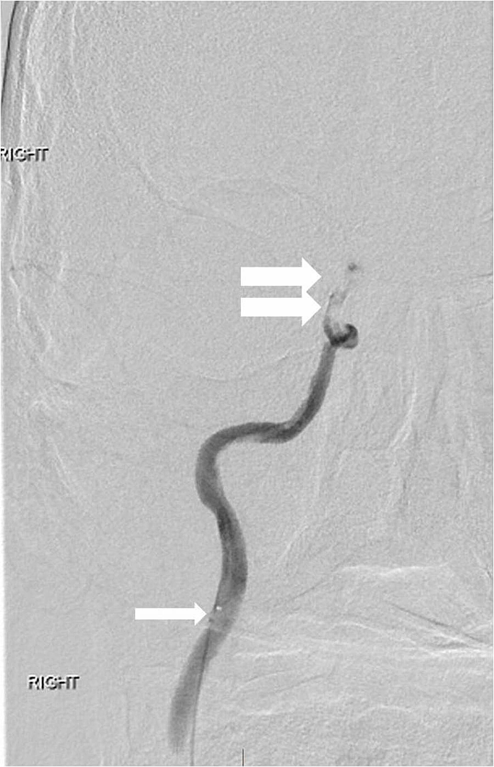 Anterior-view-right-internal-carotid-artery-injection-through-the-microcatheter-(single-arrow)-is-performed-beyond-the-occlusion